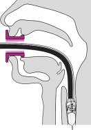 gastroduodenal FTRD® - Ovesco Endoscopy AG