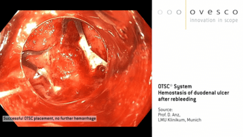 Ovesco Endoscopy AG - OTSC® System